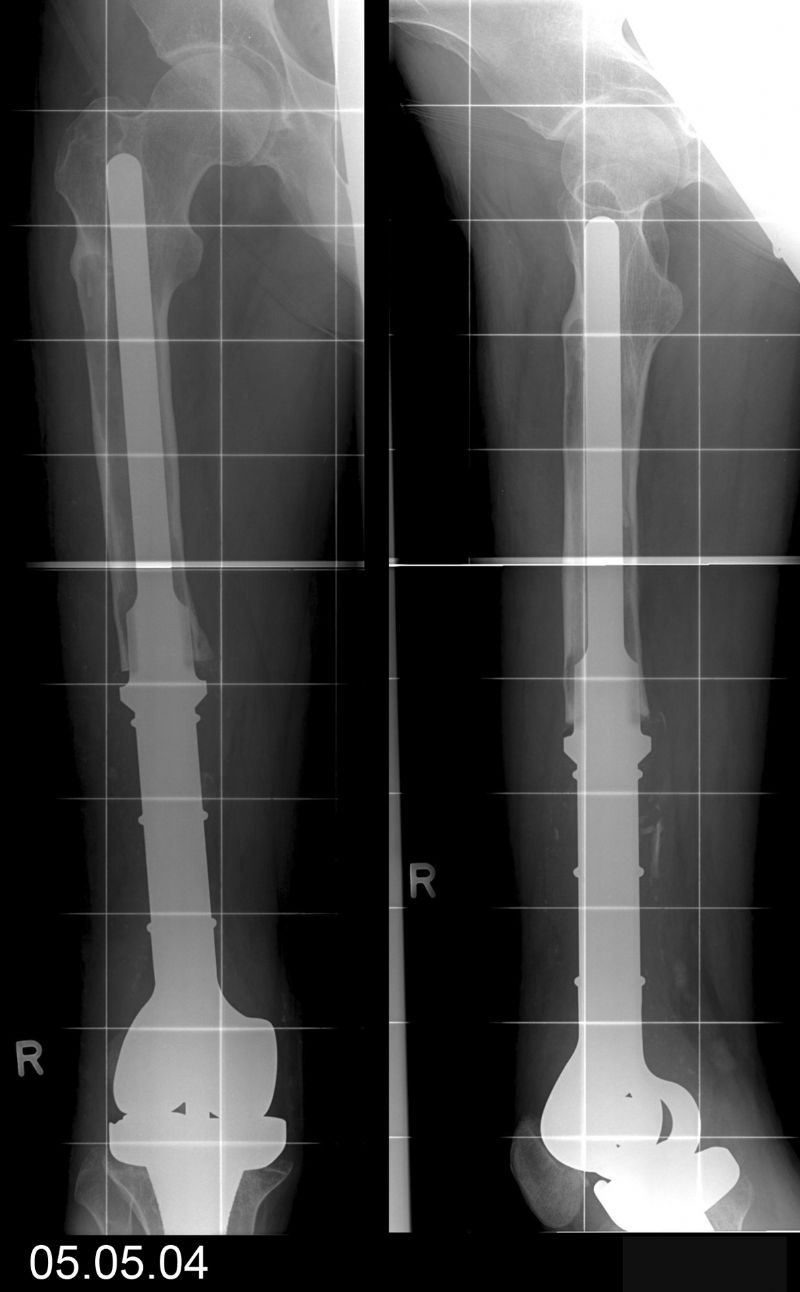 Endlock Tumor Prosthesis (Implant 4254)